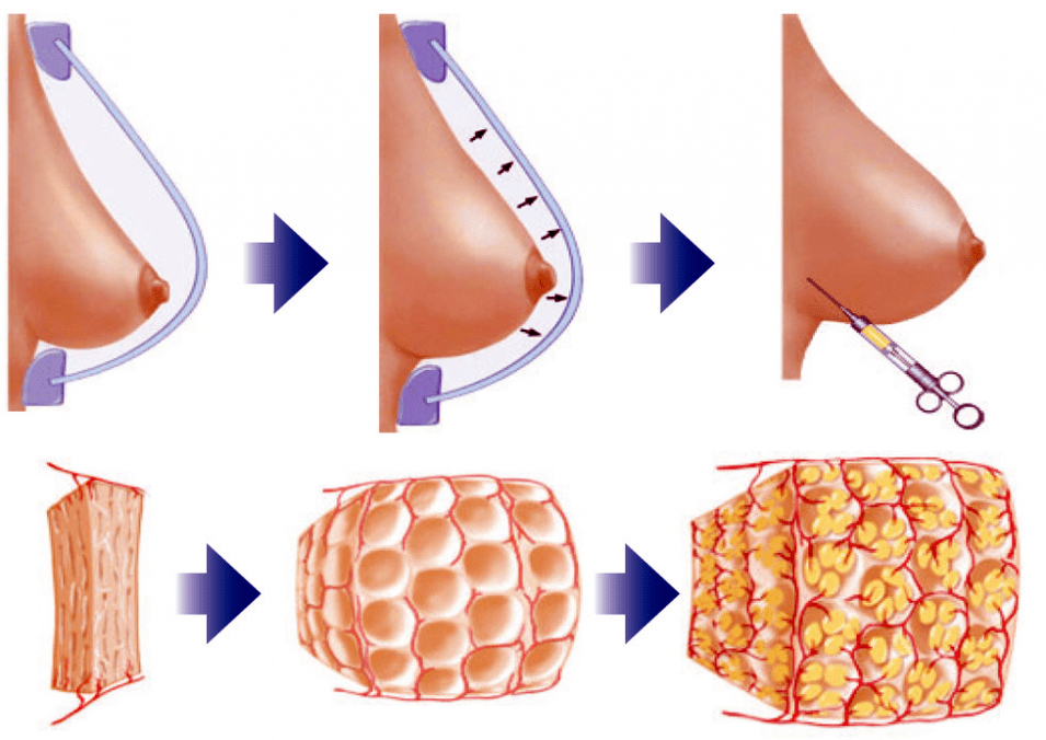 chirurgie d'augmentation mammaire