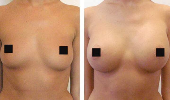 Seins avant et après l'augmentation de l'acide hyaluronique
