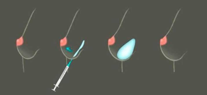 Élargissement du sein à l'aide d'injections basées sur l'hyaluronate