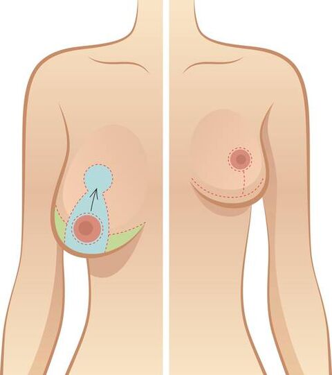 L'affaissement des seins est une indication de l'opération
