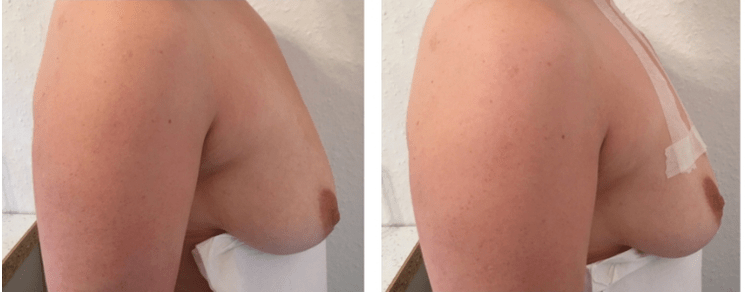 Avant et après le lifting des seins avec fil