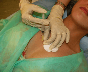 Introduction du méso-cocktail dans le tissu mammaire - une alternative aux injections d'acide hyaluronique