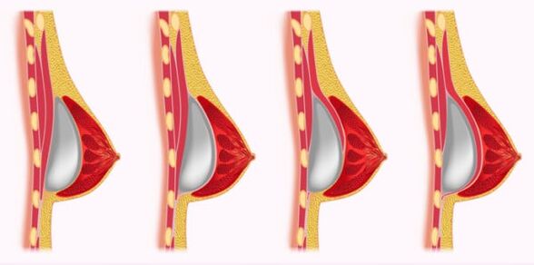 méthodes d'installation d'implants pour l'augmentation mammaire