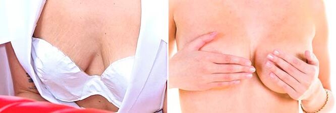 Seins flasques et asymétriques – indications d'utilisation de l'acide hyaluronique